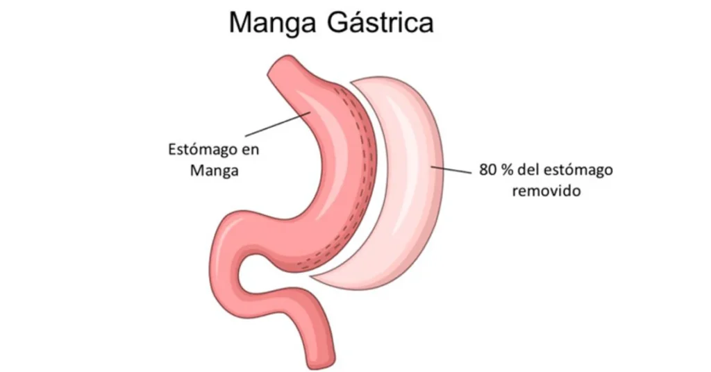 Dr_David_Cabrera_ MANGA-GÁSTRICA_reduccion_de_peso
