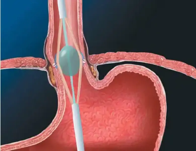 Dr_David_Cabrera_ reflujo_gastrico_stretta_dr_david_cabrera