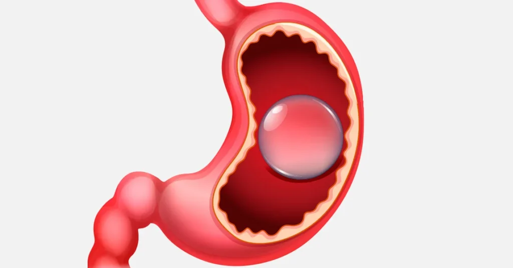 Dr_David_Cabrera_ reduccion_de_peso_balon_intragastrico_dr_david_cabrera